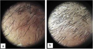 Imagen a la dermatoscopia de un paciente con alopecia androgenética. a) Antes de la intervención (198 pelos/cm2). b) Después de dos meses (308 pelos/cm2).