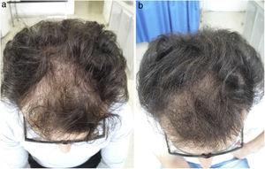 Imagen clínica de un paciente con alopecia androgenética a) pretratamiento y b) a los 6 meses de la primera inyección de plasma rico en plaquetas.