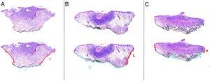 A)Extirpación de carcinoma basocelular nodular con márgenes laterales (rojo) y profundo (azul). B)Esta extirpación de carcinoma basocelular demuestra que la angulación pronunciada del bisturí puede hacer que un margen pase a ser considerado de «lateral» (L) a «profundo» (D). C)Esta extirpación de un carcinoma basocelular infiltrativo demuestra dos puntos en los que el tumor se acerca al borde de resección (estrellas). En uno está muy cerca (estrella roja) y ha sido considerado como borde lateral. En otro (borde profundo, estrella azul) el tumor contacta con la tinta de marcaje.