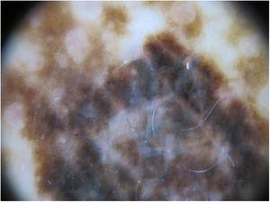 Imagen dermatoscópica en la que se aprecia el retículo atípico y áreas azul gris.