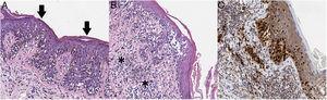 A) En el análisis histopatológico se aprecia una neoplasia melanocítica atípica de crecimiento lentiginoso, con diseminación pagetoide (flechas) y apolillamiento de la epidermis (hematoxilina-eosina, ×200). B) En otras áreas se observan melanocitos atípicos infiltrando la dermis en su parte más superficial (asterisco), asociados a fibroplasia de dermis papilar e infiltrado inflamatorio (hematoxilina-eosina, ×200). C) Con inmunohistoquímica se aprecia positividad nuclear en los melanocitos intradérmicos e intraepidérmicos (Sox10, ×200).