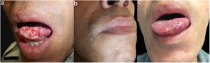 a) Úlcera en la lengua; b) pápulas perladas moluscoides en el labio superior; c) lesión reepitelizada tras el tratamiento.