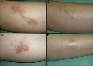 Caso 2. Mujer de 32 años, afecta de DM1 y necrobiosis lipoídica de menor tiempo de evolución (8 meses). Aspecto de las lesiones al inicio (A y B) y tras finalizar el tratamiento con TFD convencional con MAL (C y D).