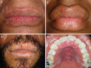 Lesiones asociadas a lepra. 1) Placa leprosa en los labios superior e inferior. 2) Lepromas en el labio superior. 3) Lepromas en los labios superior e inferior. 4) Leproma en el paladar.