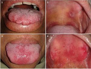 Lesiones no asociadas a lepra. 1) Fibroma traumático en la lengua. 2) Úlcera traumática en el paladar. 3) Candidiasis eritematosa en la lengua. 4) Estomatitis subprotésica en el paladar.