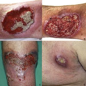 a) Pioderma gangrenoso ulcerativo en pierna derecha (abril 2005). b) Pioderma gangrenoso ulcerativo en pierna derecha (octubre 2009). c) Detalle de pioderma gangrenoso ulcerativo de 10 x 6 cm en pierna izquierda (julio 2015). d) Pioderma gangrenoso ulcerativo en axila izquierda (mayo 2017).