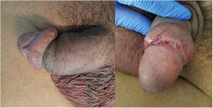 Linfogranuloma venéreo en pene en un paciente seropositivo para el VIH. Úlceras en surco balanoprepucial y linfedema de prepucio.