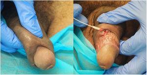 Linfogranuloma venéreo en pene en un paciente seropositivo para el VIH. Absceso en el área del prepucio con fistulización a la piel.