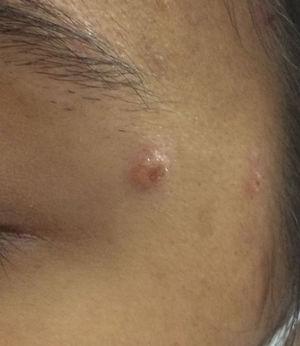 Lesión moluscoide en la cara.