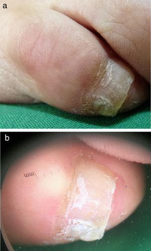 Imagen clínica del quinto de dedo del pie: a) dedo derecho, b) dedo izquierdo que presenta una rotación externa y aumento de tamaño de la uña con una fisura longitudinal que divide la lámina ungueal.