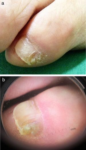 Dermatoscopia del quinto dedo de pie: a) dedo derecho; b) dedo izquierdo.