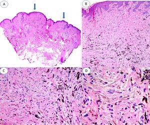 A) Panorámica de la lesión en la que se observan 2 áreas de nevus azul, una de unos 3mm y otra de aproximadamente 1mm (flechas). B) Nidos compactos de melanocitos fusiformes, localizados en dermis papilar y reticular alta sin presencia de nidos en la unión dermoepidérmica (H&E ×4). C) Detalle de la distribución de melanina, con gránulos más densos en la parte más profunda de la lesión (H&E ×10). D) Detalle de los melanocitos que muestra núcleos monomorfos, ausencia de mitosis o necrosis (H&E ×20).