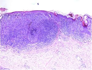 Presencia de intenso infiltrado linfocitario en toda la base del melanoma cutáneo. Hematoxilina y eosina, ×40.