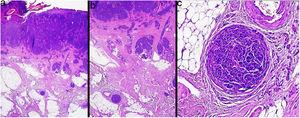 Presencia de micrometástasis (microsatelitosis) de melanoma profundo al tumor primario. Hematoxilina y eosina, a) ×40, b) ×100, c) ×200.