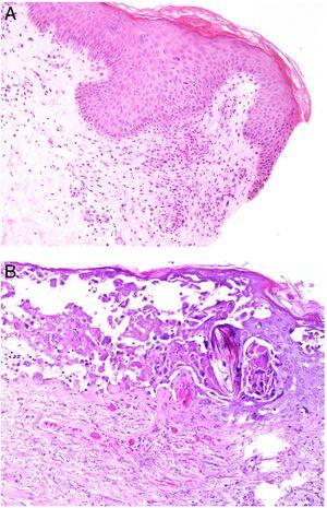 A: Sarampión. Se observa ligera paraqueratosis focal y exocitosis linfocitaria ligera, así como algunos queratinocitos apoptóticos. En la capa basal, se observan epiteliotropismo a expensas de polimorfonucleares y, en dermis papilar subyacente infiltrado inflamatorio mixto y vasos con trombos, así como extravasación de algunos hematíes (H&E 100x). B: Varicela. Vesícula intraepidérmica en la que se observan células acantolíticas, células con marginación de la cromatina, células multinucleadas y, en la dermis subyacente, capilares dilatados con trombos de fibrina y extravasación hemática (H&E 100x).