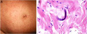 A: Lesiones purpúricas situadas en el abdomen de una paciente inmunodeprimida con estrongiloidiasis diseminada. B: Larva de Strongyloides stercoralis entre los haces de colágeno de la dermis (H&E 60x).