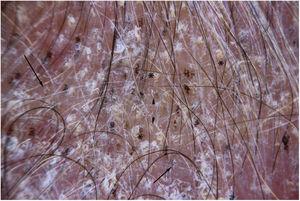 Dermatoscopia; pelos en coma (flecha); pelos en tirabuzón (*) asociados a pelos rotos (punta flecha).