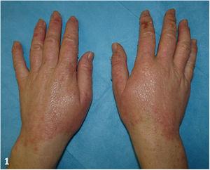 Pápulas y placas descamativas con bordes definidos en el dorso de los dedos de ambas manos.
