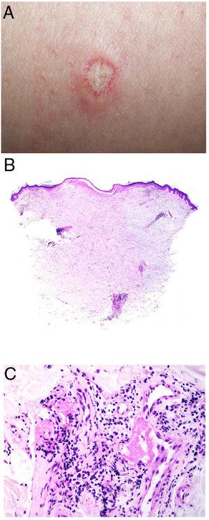 Enfermedad de Degos. A: Las pápulas atróficas con centro blanquecino porcelánico y halo eritematoso telangiectásico se consideran un hallazgo patognomónico de la enfermedad. B: Infarto en forma de cuña con el vértice hacia abajo. En la punta del vértice se observa un vaso con discreto infiltrado linfocitario crónico perivascular (H&E 20x). C: Detalle del vaso mencionado en B, con numerosos trombos intravasculares (H&E 400x).