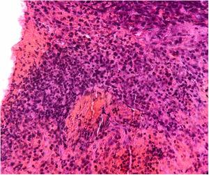 Tumor de células pequeñas basófilas (100x).