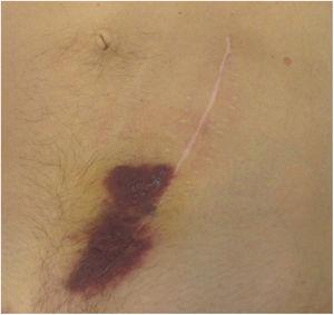 Sarcoma de Kaposi cutáneo en la cicatriz quirúrgica.