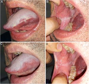 Lesiones blanquecinas de aspecto arrugado, localizadas en laterales de la lengua A) y mucosa yugal B). Mejoría clínica de las lesiones tras tratamiento con doxiciclina oral, tanto en lateral de la lengua C) como en mucosa yugal D).