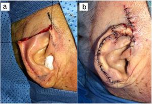 Defecto quirúrgico después de la resección (a). Posicionamiento y sutura de los colgajos (b).