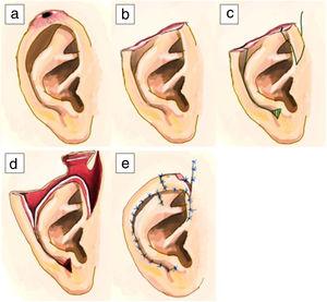 Esquema paso a paso de la técnica de Antia-Buch para el polo superior: lesión en el polo superior de la oreja (a). Defecto después de la resección del tumor (b). Diseño de los colgajos (c). Disección de los colgajos condrocutáneos (d). Posicionamiento y sutura de los colgajos (e).