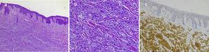 Imagen histológica típica de un TCG cutáneo: a) imagen a pequeño aumento donde se observa la proliferación dérmica de células con citoplasma granular y cierta hiperplasia epidérmica suprayacente (hematoxilina-eosina×40); b) imagen a gran aumento con un detalle de las células granulares (hematoxilina-eosina×200); c) tinción inmunohistoquímica positiva para S100 al nivel de las células granulares (tinción para proteína S100×100).