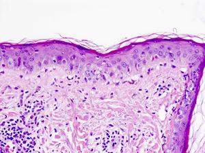 Dermatitis de interfase (HE×40). Se observa presencia de atrofia epidérmica junto a una dermatitis de interfase vacuolar con queratinocitos necróticos, junto a un infiltrado perivascular superficial de predominio linfocitario. Esta biopsia corresponde a una paciente con lupus cutáneo.