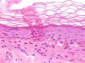Penfigoide ampolloso en fase urticarial (HE×100). En la epidermis podemos evidenciar la presencia de espongiosis, junto a un infiltrado con abundantes eosinófilos dispuestos en la dermis superficial y en la unión dermoepidérmica. Se observa el inicio de la formación de una vesícula subepidérmica, hallazgos concordantes con el diagnóstico de penfigoide ampolloso.