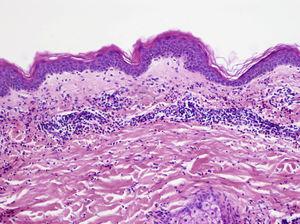Vasculitis urticarial (HE×10). Se observa una epidermis sin alteraciones, con inflamación perivascular superficial de predominio linfohistiocitario, junto a aislados eosinófilos y neutrófilos perivasculares. Además, destaca la presencia de edema y daño de la pared vascular de los pequeños vasos en la dermis superficial. Estos hallazgos se acompañan de extravasación de hematíes, de la presencia de leucocitoclasia intersticial así como de edema en la dermis superficial. En este caso no se observa necrosis fibrinoide. Precisó una correlación clinicohistológica para establecer el diagnóstico definitivo.