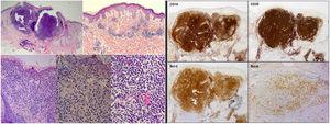 Hallazgos histopatológicos e inmunohistoquímicos de la biopsia cutánea. A la izquierda, tinción de hematoxilina-eosina (H-E) con imágenes de menor a mayor aumento al miscroscopio óptico que muestran las características histológicas del linfoma cutáneo B centrofolicular: infiltrado linfocitario localizado en dermis media y profunda con patrón de crecimiento mixto (nodular/difuso) y presencia de células de hábito centrocítico y centroblástico. A la derecha, panel inmunohistoquímico compatible con linfoma centrofolicular primario cutáneo. Se evidencia positividad para CD10, CD20, Bcl-2 y Bcl-6 (hematoxilina-eosina, x2, x4, x10, x20, x20; IHQ, x2, x2, x2, x4).