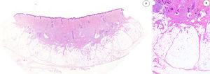 A) Panorámica de HE que muestra una lesión mal delimitada en dermis reticular con cantidades variables de tejido adiposo, fibroblástico y mesenquimal inmaduro. B) A mayor aumento se observan bandas densas de tejido fibroso proyectándose en el tejido graso maduro. HE: hematoxilina-eosina.