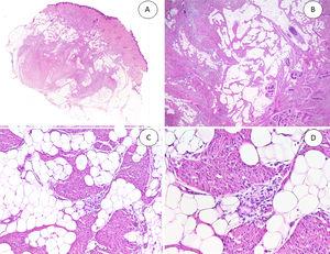 A) HFI dérmico e hipodérmico B) A mayor aumento, bandas densas de tejido fibroso proyectándose en el tejido graso maduro. C) Trabéculas entrelazadas de tejido fibroso que presentan colecciones de fibrocitos de aspecto inmaduro en patrones de espiral. D) Componente mesenquimatoso inmaduro basófilo entremezclado con tejido fibroso. HFI: hamartoma fibroso de la infancia.