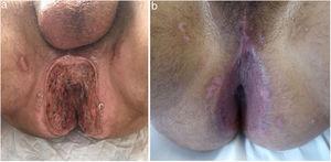 a) Aspecto inicial de la ulceración perianal del caso 7. b) Completa reepitelización alcanzada en el caso 7 tras los injertos de piel parcial.