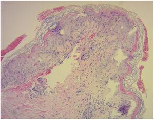 Se observan queratinocitos necróticos en la epidermis y satelitosis, vacuolización de la capa basal y despegamiento dermoepidérmico (H&E, ×10).