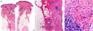 Biopsia cutánea de una de las pacientes. A) Epidermis normal, con lesiones centradas en dermis y tejido celular subcutáneo (hematoxilina-eosina, 4x). B) Áreas de esclerosis junto a hiperplasia folicular linfoide e infiltrado histiocitario (hematoxilina-eosina, 4x). C) Histiocitos con citoplasma granular (hematoxilina-eosina, 20x).