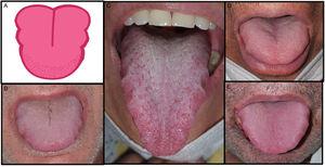 Pacientes con enfermedad por COVID-19 con un característico edema lingual o macroglosia (6,6%) asociado a papilitis lingual transitoria en U (11,5%). A) Ilustración de los cambios en la lengua con la marcación de las indentaciones en los laterales de la lengua e inflamación de las papilas anteriores probablemente por el roce. B-E) Pacientes con edema lingual y papilitis lingual transitoria en U durante la enfermedad COVID-19.