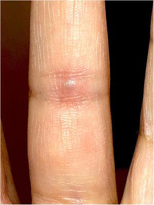 Nódulo violeta azulado en el dedo, a nivel de la articulación interfalángica proximal.