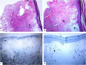 Liquen escleroso genital (vulvar). A y B) Las características de LiE incluyen la epidermis notablemente atenuada con una transición de la dermis papilar edematosa (estrella) al colágeno dérmico hialinizado homogeneizado (flecha) y un infiltrado sutil de células inflamatorias (punta de flecha). C y D) La tinción de CD34 muestra la pérdida de células dendríticas dérmicas marcadas con CD34 y un aumento de la densidad de microvasos (puntas de flecha). (Ampliaciones originales. A:×40; B:×100; C:×40, y D:×100).