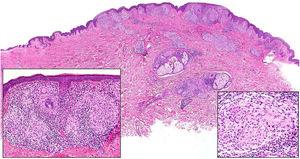 Lepra tuberculoide. Esta muestra de lepra tuberculoide, correspondiente al paciente de la figura 20A, muestra un infiltrado linfohistiocitario con una distribución «en salchicha» que sigue los haces neurovasculares (H&E, ×20). En el recuadro inferior izquierdo se aprecian granulomas epitelioides rodeados por linfocitos (H&E, ×100). En el recuadro inferior derecho se reconoce un nervio en el centro del granuloma (H&E, ×100).