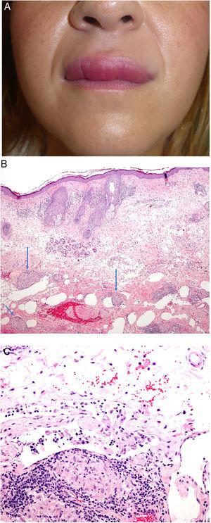 A) Queilitis granulomatosa. Marcado edema del labio superior. B) Queilitis granulomatosa. Piel de labio con marcado edema dérmico, ectasia vascular, discreta infiltración linfocitaria y granulomas epitelioides peri e intravasculares (flechas) (H&E ×40). C) Queilitis granulomatosa. Vaso linfático dilatado con agregados histiocitarios intravasculares y un granuloma perivascular (H&E ×200).