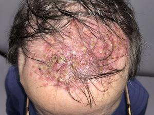 Amplia zona de alopecia cicatricial en el cuero cabelludo con pústulas y costras perifoliculares.