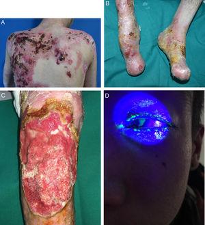 Complicaciones extracutáneas en pacientes con EBDR. Paciente con EBDR sobreinfección local cutánea (Fig. 2A); pseudosindactilia en manos y pies (Fig. 2B); carcinoma epidermoide en rodilla de paciente con EBDR (Fig. 2C); úlcera corneal epitelial fluoresceína positiva (Fig. 2D).
