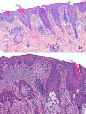 a) Hiperplasia epidérmica con llamativas espículas queratósicas en el ostium folicular, y paraqueratosis más acentuada alrededor del infundíbulo piloso. En la dermis el infiltrado linfocitario es perivascular (H-E, ×40). b) La epidermis muestra acantosis con hiperqueratosis, tapones córneos y paraqueratosis frecuentemente de localización perifolicular. No se observan abscesos de Munro. La capa granulosa está engrosada. Hay leve espongiosis con exocitosis linfocitaria. En la dermis el infiltrado es linfocitario y perivascular. Hay degeneración basófila del colágeno sin incremento de mucina. (H-E, ×100).