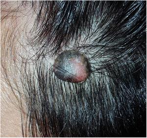 Aspecto clínico de la lesión localizada en la zona frontoparietal del cuero cabelludo.