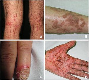 Apariencia clínica típica de AiKD: A) Queratosis liquenoide crónica; B) Poroqueratosis; C) Acrodermatitis continua de Hallopeau; D) Psoriasis pustulosa.
