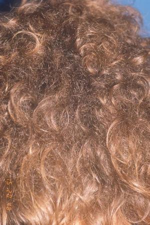 Ensortijamiento progresivo del cabello. Múltiples cabellos ensortijados y más finos entre el cabello normal.