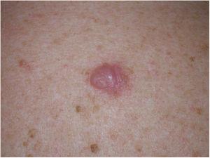 Imagen clínica de un MD. Mujer de 53 años con tumoración interescapular en forma de tumor rosado de tacto firme. Había sido inicialmente orientada de queloide. La biopsia reveló un MD puro de 8,5 mm de espesor.